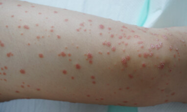 GUTTATE PSORIASIS: Også kalt dråpeformet psoriasis. Her er utslettet lokalisert som små "dråper" på leggen til en ung pasient. FOTO: NTB Scanpix / Shutterstock GUTTATE PSORIASIS: Også kalt dråpeformet psoriasis. Her er utslettet lokalisert som små "dråper" på leggen til en ung pasient. FOTO: NTB Scanpix / Shutterstock